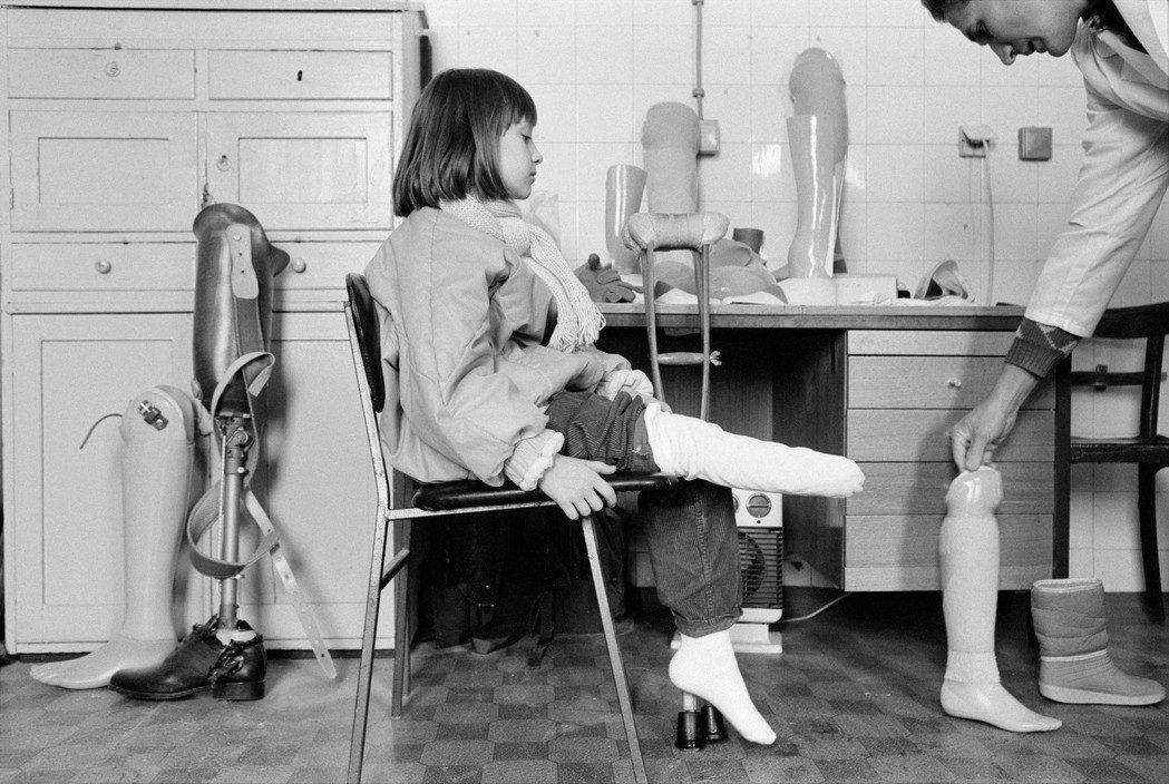 Nine year old Samra Grafo had a foot amputated in July 1993, when a Serb mortar shell landed outside her house. For the first time she tries on an artificial leg at the Neretva Orthopedic Center. Sarajevo. 1993.