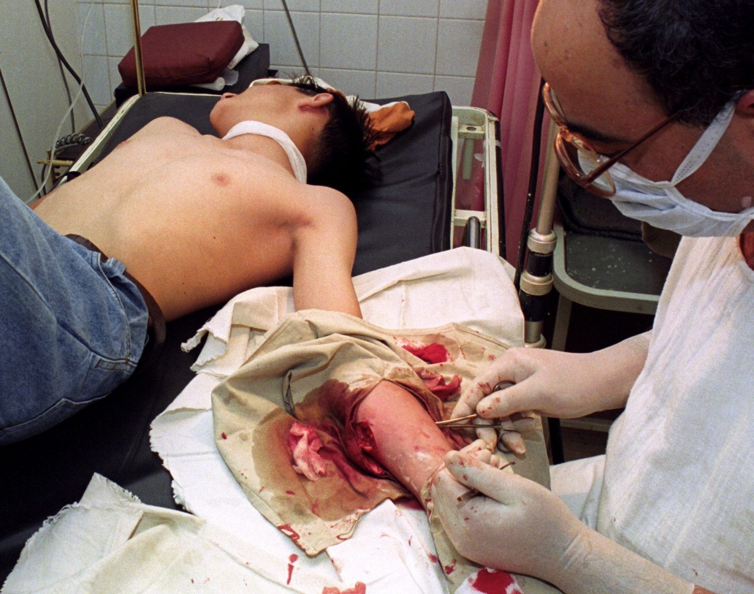 A wounded teenager is treated in the hospital after the mortar attack by Serb Forces in Sarajevo, Bosnia And Herzegovina, 1 June 1993. Eleven people, four of them children, were killed in the attack.