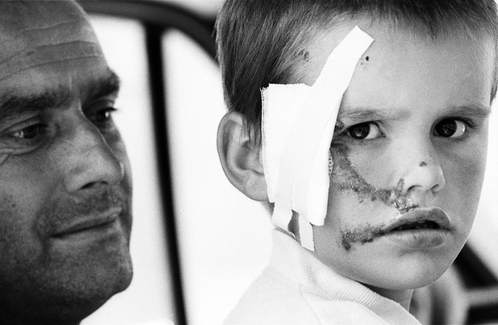 Sarajevo, Bosnia. Kosevo Hospital, boy wounded by grenade splints.