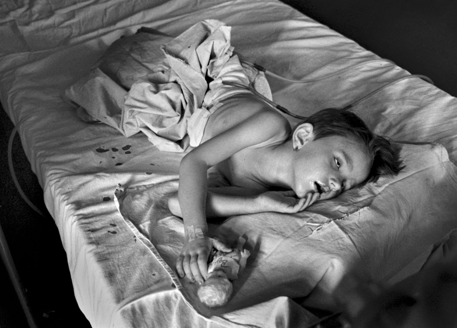 Five-year-old Irma Hadzimuratovic lies seriously injured in a Sarajevo hospitial on August 5 1993. She was injured by a Serb mortar shell 6 days ago which killed her mother and 14 others in a market square in Bosnia's capital, Sarajevo.