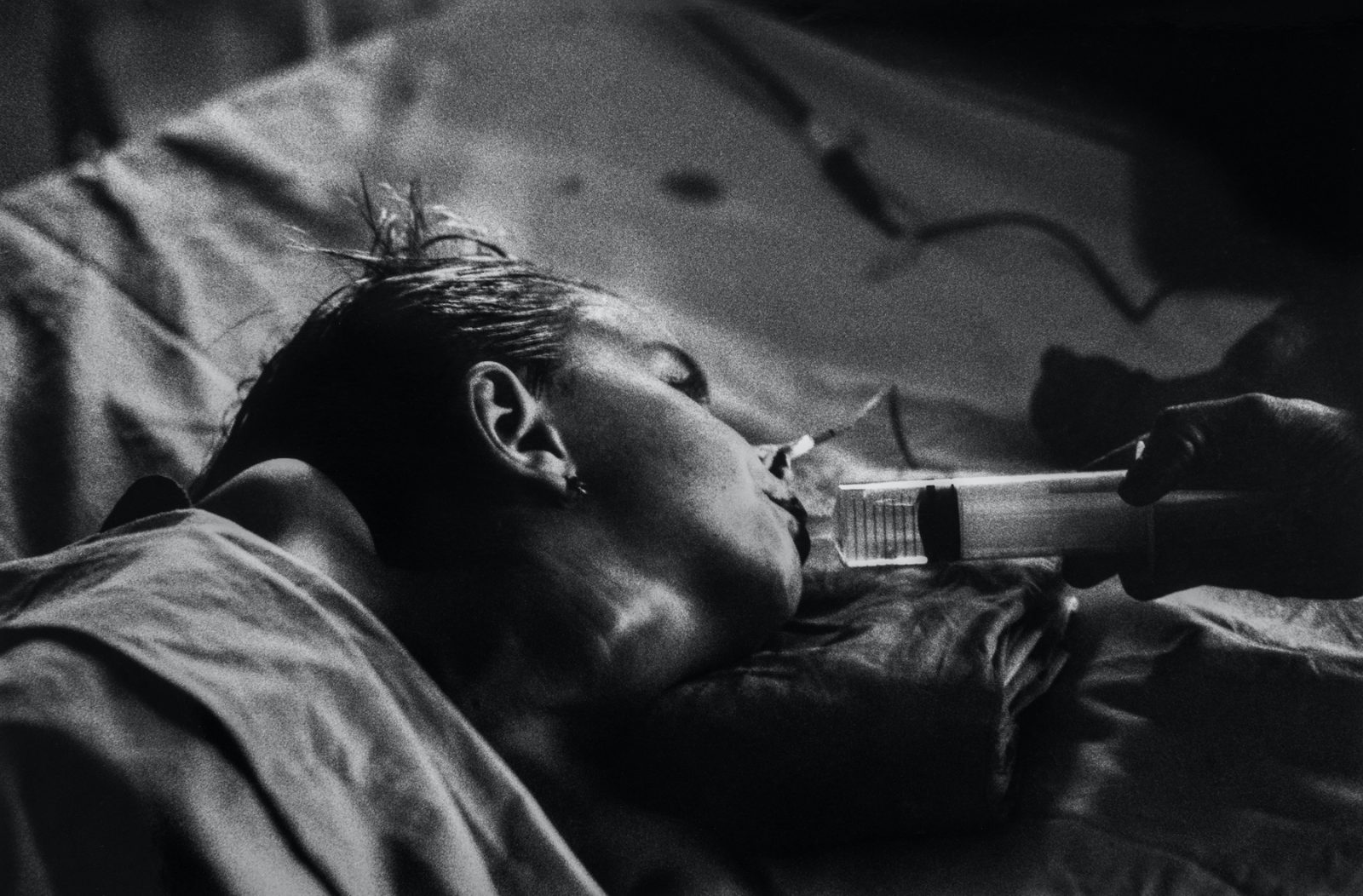 Irma Hadzimuratovic whose suffering has come to symbolise the agony of Bosnia, lies on a hospital bed. 5 year old Irma was seriously injured by a Serbian mortar bomb which killed her mother and 14 others in a market square in Bosnia's capital, Sarajevo in august 1993. She was eventually airlifted to the UK where she was treated but sadly died there in 1995.