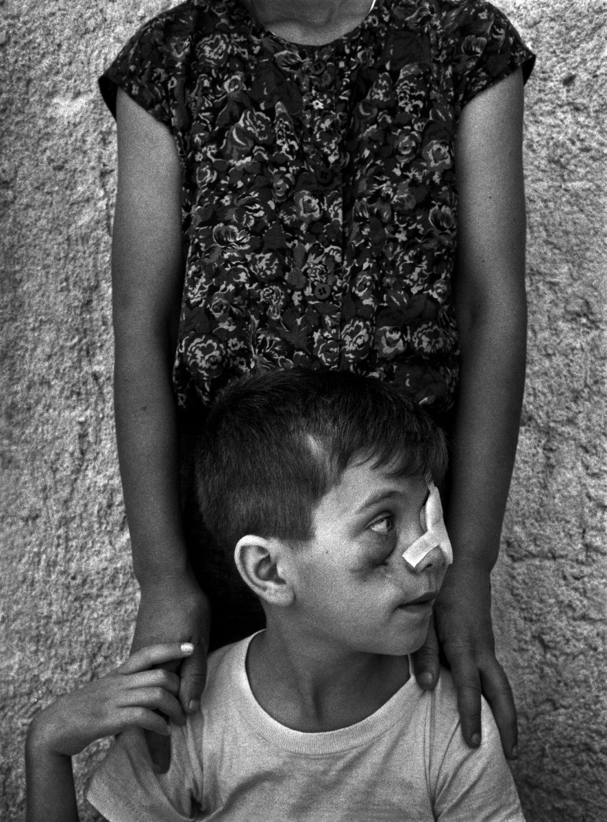 At the age of 11 , Edhem Dedovic was badly wounded in a mortar attack on his neighbourhood of Sarajevo in which he lost his left eye. He was one of a group of wounded children to be evacuated abroard for treatment by the UN. He was accompanied by his Sister Alisa and Mother Alija to Sweden and the UK.