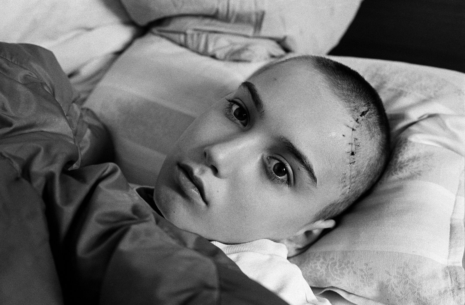 Injured boy in Kosevo hospital, January 1993, Sarajevo.